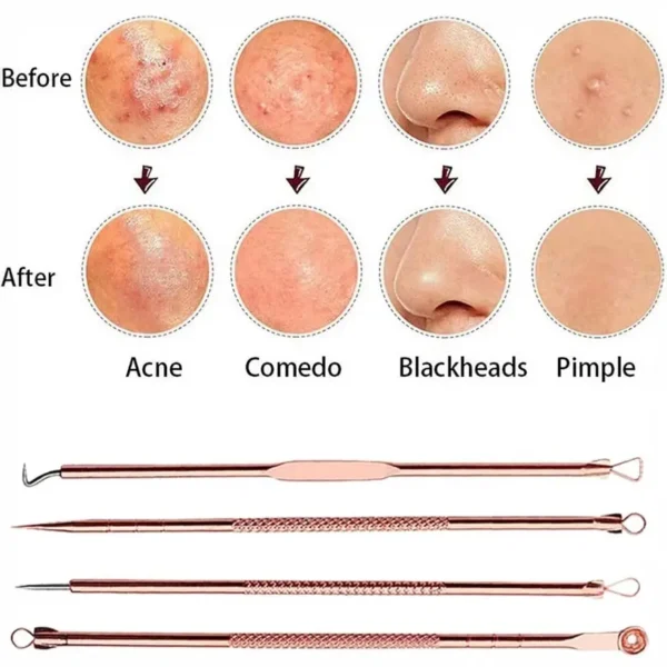 مجموعة ازالة الرؤوس السوداء 4 قطع ستانلس لتنظيف البشرة وازالة البثور وحب الشباب بسهولة